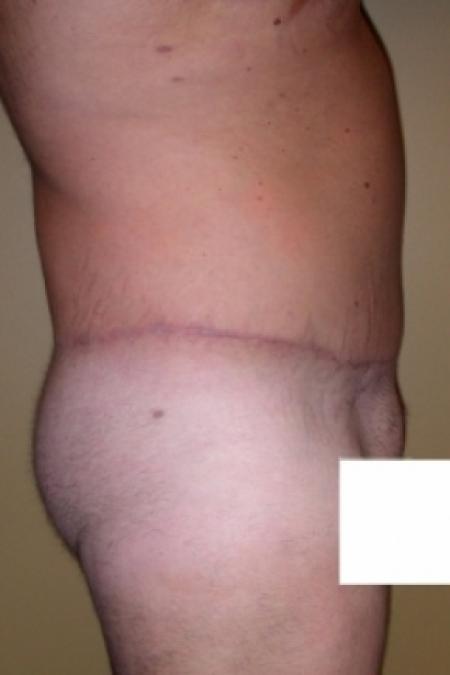 After image 3 Case #79796 - Male Tummy Tuck
