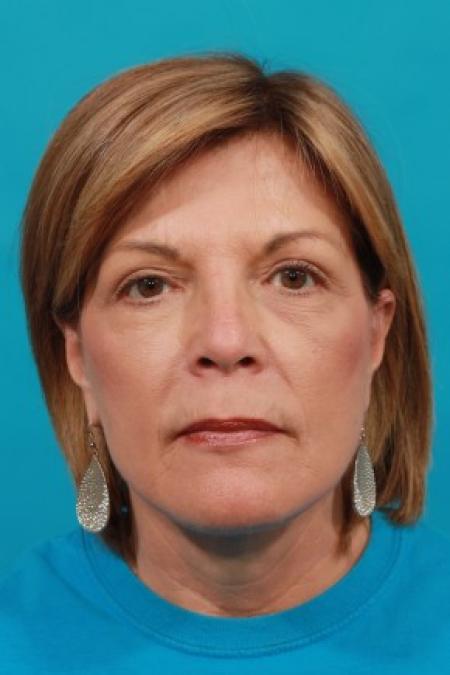 After image 1 Case #85636 - Face Lift with Upper Blepharoplasty