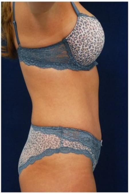 After image 3 Case #82121 - Tummy Tuck