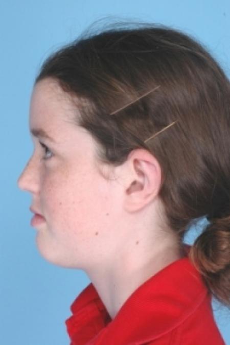 After image 2 Case #79521 - Ear Surgery