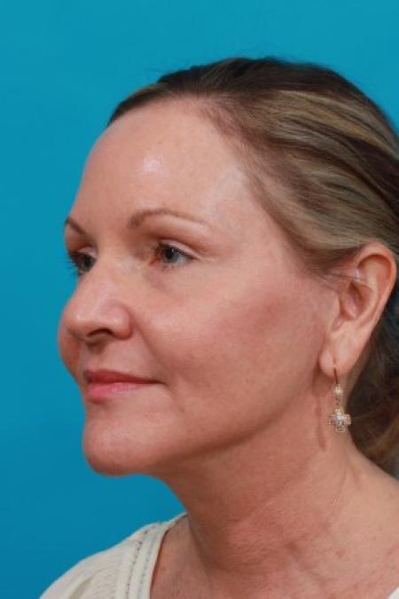 After image 2 Case #82991 - Facial Rejuvenation