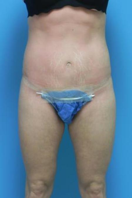 After image 1 Case #80941 - Abdominoplasty