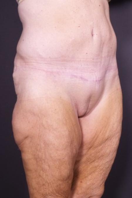 After image 2 Case #85821 - Skin-only Abdominoplasty