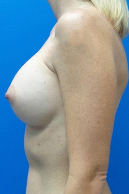 After image 3 Case #87296 - Silicone Breast Augmentation