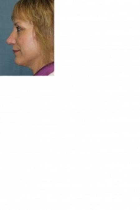 After image 3 Case #81166 - Nose Reshaping
