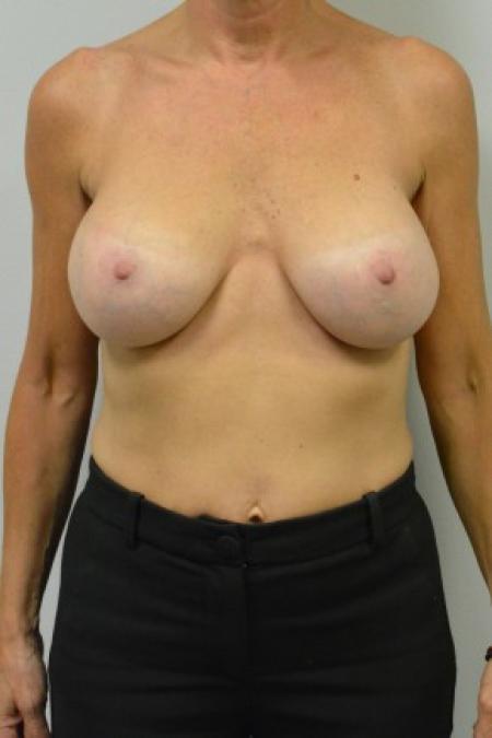 After image 1 Case #88101 - 45-55 year woman treated with Ideal Structured Saline Implants