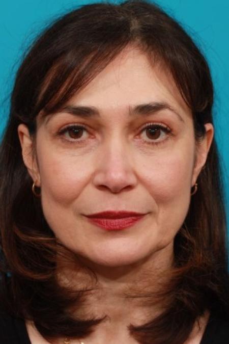 After image 1 Case #85631 - Brow and Eyelid Lift
