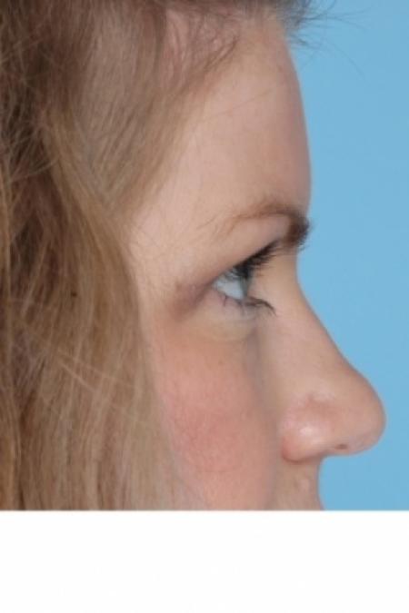 After image 2 Case #80586 - Upper Blepharoplasty