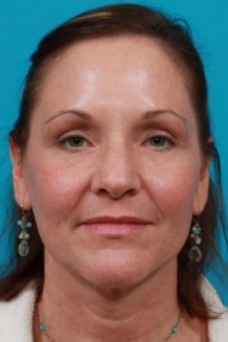 After image 1 Case #78891 - Upper Blepharoplasty