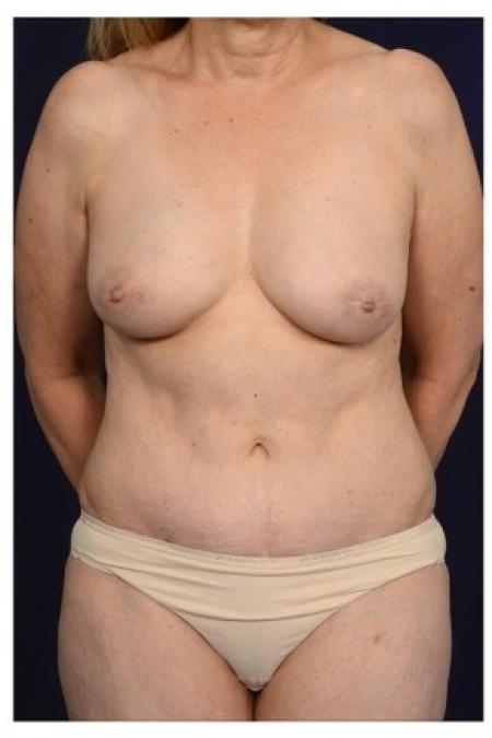 After image 1 Case #84756 - Mommy Makeover
