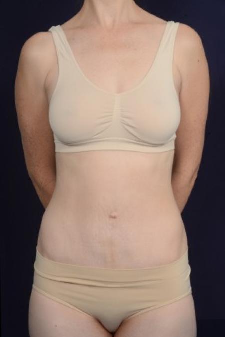 After image 1 Case #87601 - Mommy Makeover