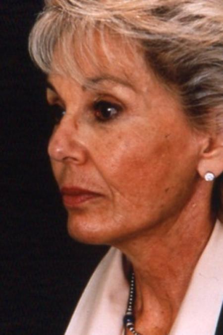 After image 2 Case #81501 - Facelift