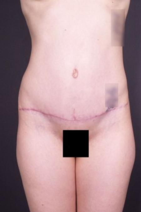 After image 1 Case #85826 - Abdominoplasty
