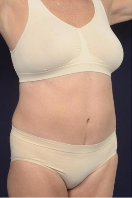 After image 2 Case #87521 - Trunk Liposuction