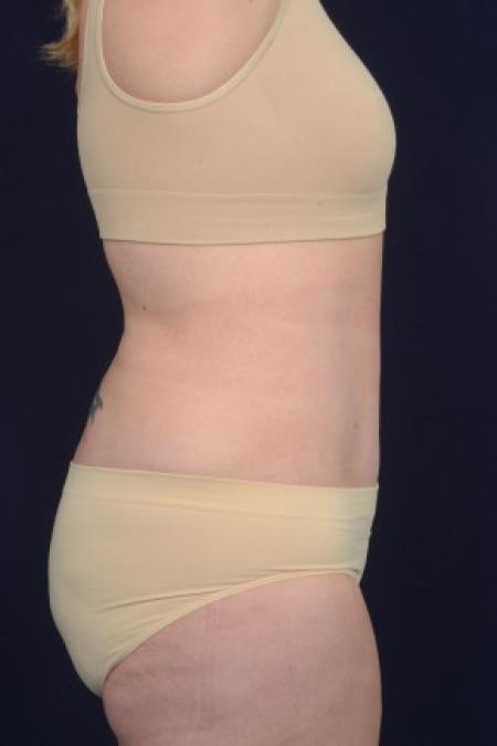After image 3 Case #87546 - Abdominoplasty