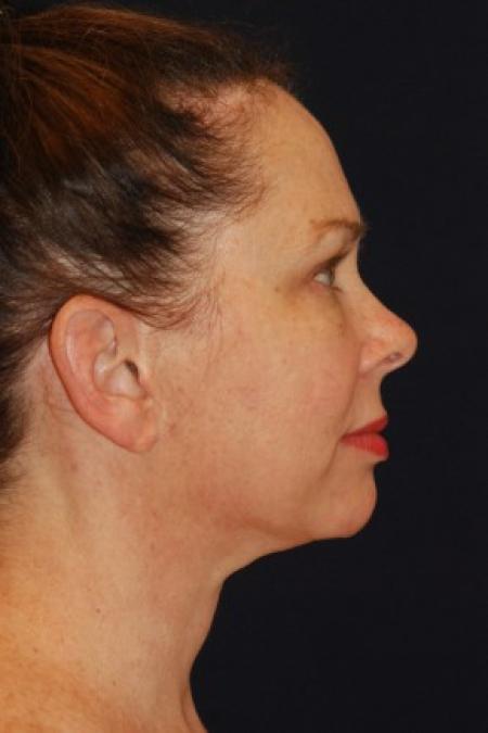 After image 3 Case #87756 - Full Facial Rejuvenation