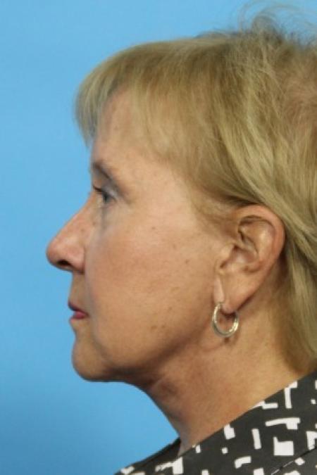 After image 3 Case #82986 - Full Facial Rejuvenation