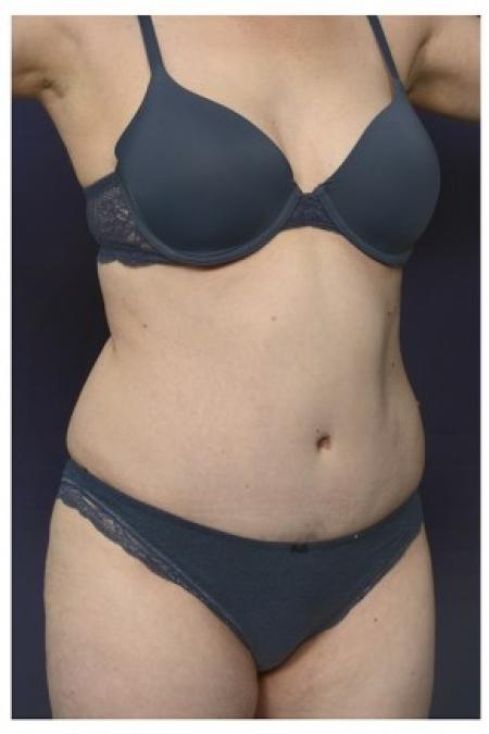 After image 2 Case #84496 - Abdominoplasty