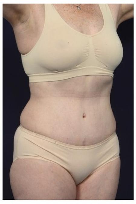 After image 2 Case #85606 - Abdominoplasty