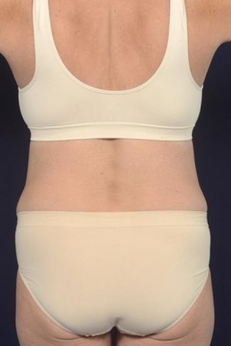 After image 4 Case #87521 - Trunk Liposuction
