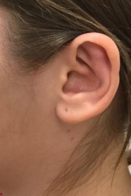 After image 1 Case #86966 - Otoplasty (Ear Surgery)