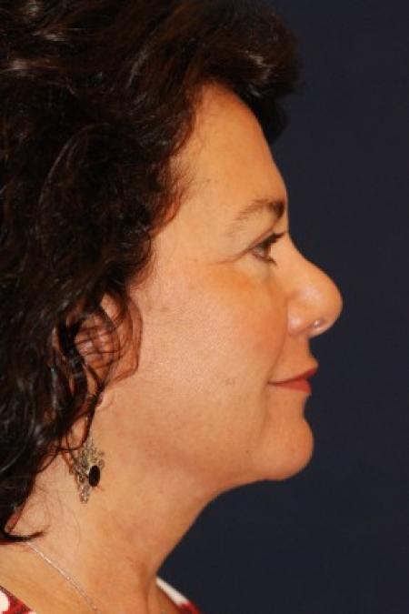 After image 3 Case #87731 - Full Facial Rejuvenation