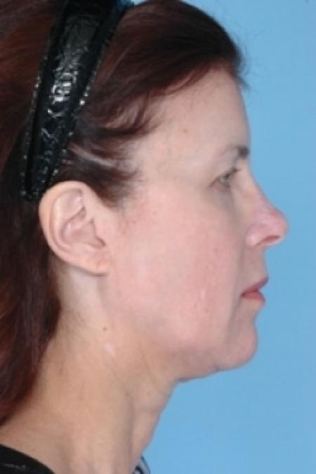 After image 2 Case #79306 - Non-Surgical Focused Ultrasound