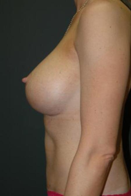 After image 3 Case #80901 - "Mommy Make-Over" Breast Augmentation and Abdominoplasty