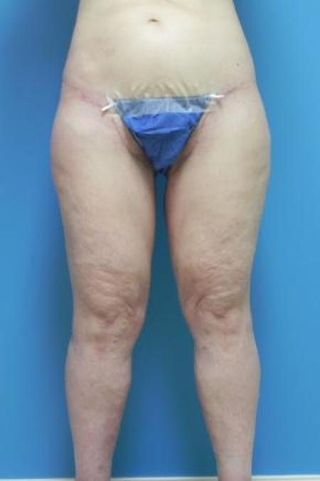 After Case #80951 - Thigh Lift