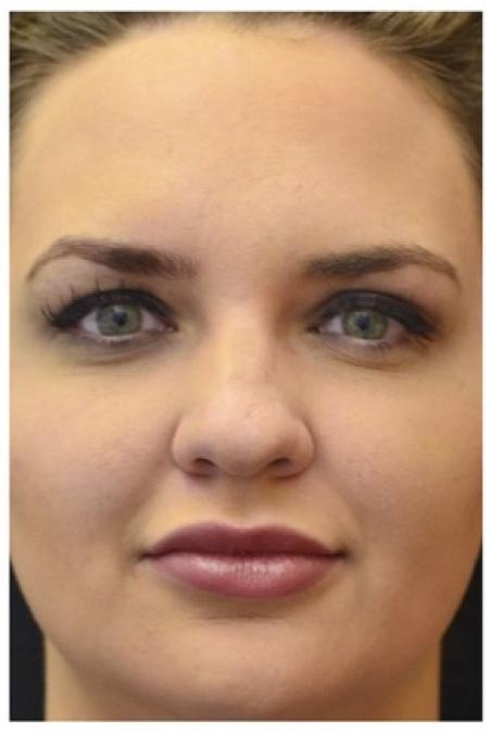 After image 1 Case #86346 - 25 year old woman treated with nonsurgical rhinoplasty