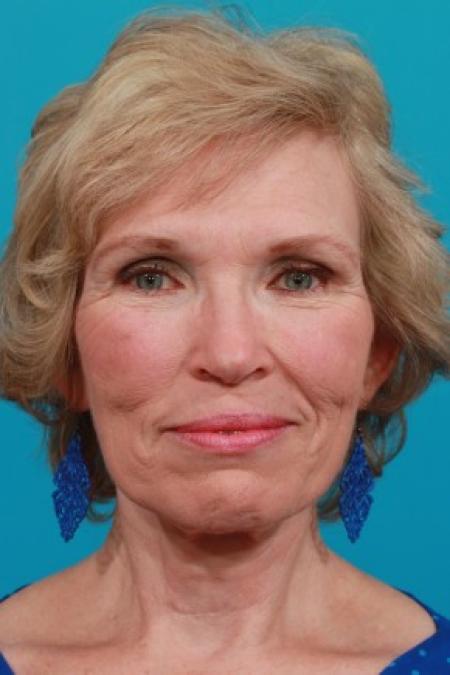 After image 1 Case #82996 - Full Facial Rejuvenation