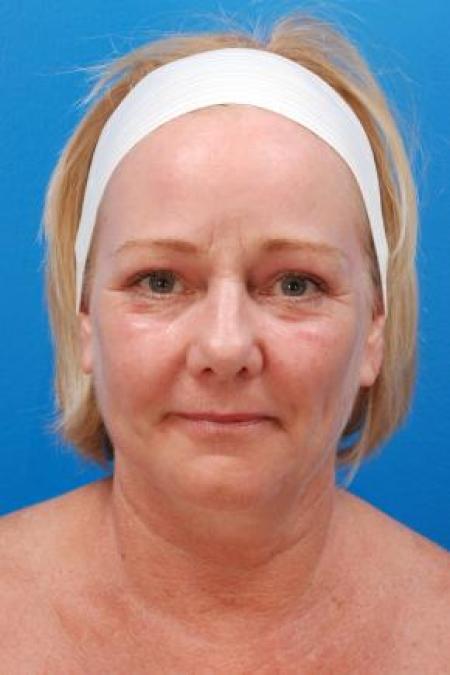 After image 1 Case #85331 - 61 y/o woman after Laser Liposuction to the neck, skin tightening, eyelid surgery, & fat grafting to the face