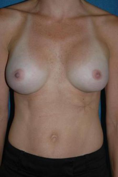 After image 1 Case #80916 - Breast Augmentation 