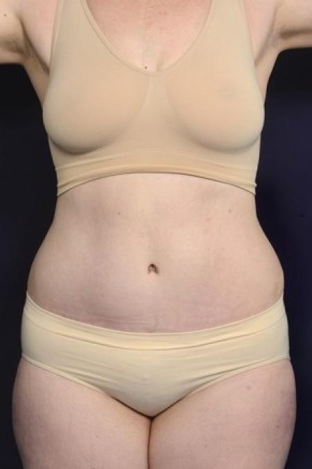 After image 1 Case #87446 - Abdominoplasty