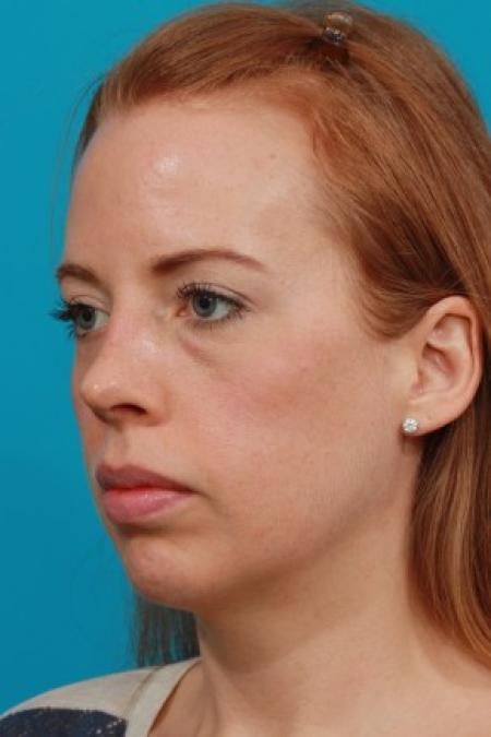 After image 2 Case #82171 - Open Septorhinoplasty