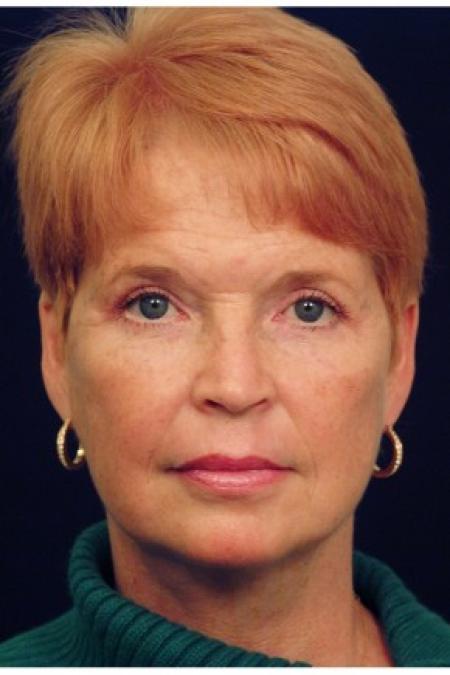 After image 1 Case #82141 - Facelift