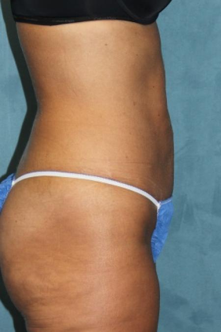After image 2 Case #80831 - Liposuction with "mini tummy-tuck"