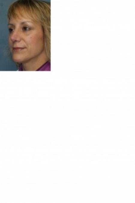 After image 2 Case #81166 - Nose Reshaping