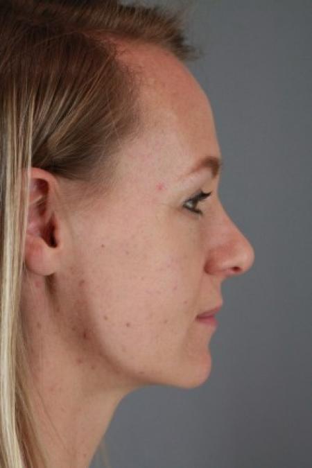 After image 3 Case #87566 - Rhinoplasty