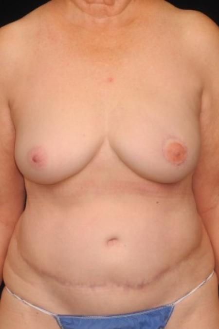 After image 1 Case #84946 - 72 y/o - Immediate Left DIEP Breast Flap Reconstruction