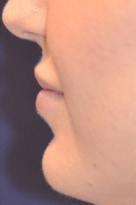 After image 2 Case #86336 - 26 year old woman treated with fillers