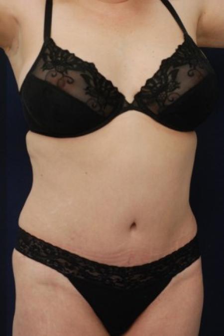 After image 2 Case #87646 - Abdominoplasty