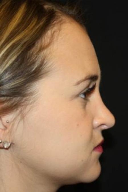 After image 3 Case #84211 - Rhinoplasty - 24 year old female.