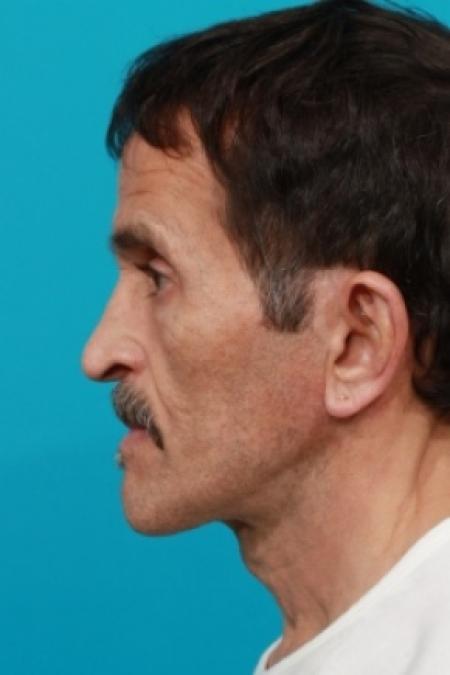 After image 3 Case #78726 - Face / Neck Lift