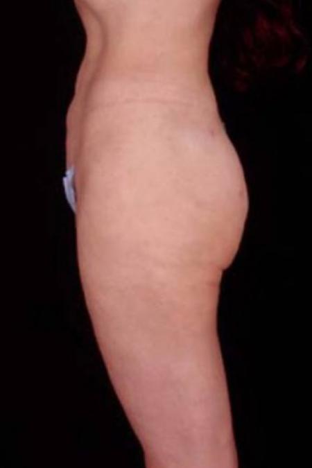 After image 2 Case #81666 - Liposuction