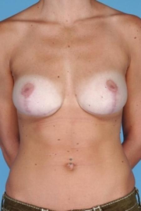 After image 1 Case #80611 - Breast Reduction 