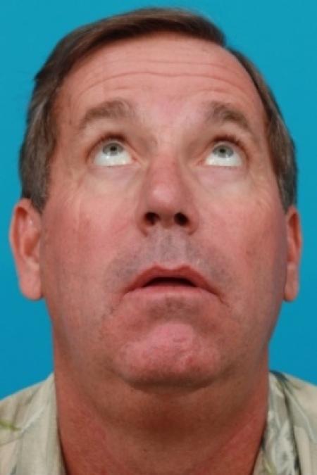 After image 3 Case #78876 - Lower Blepharoplasty
