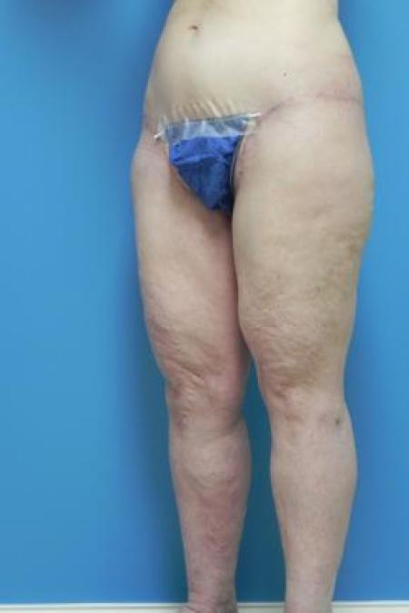 After Case #80951 - Thigh Lift