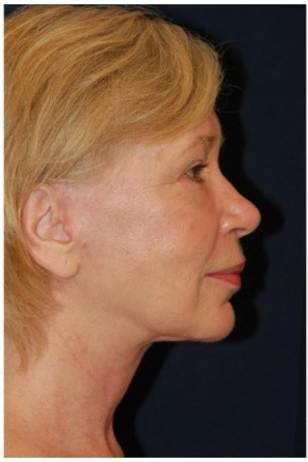 After image 3 Case #82051 - Full Facial Rejuvenation