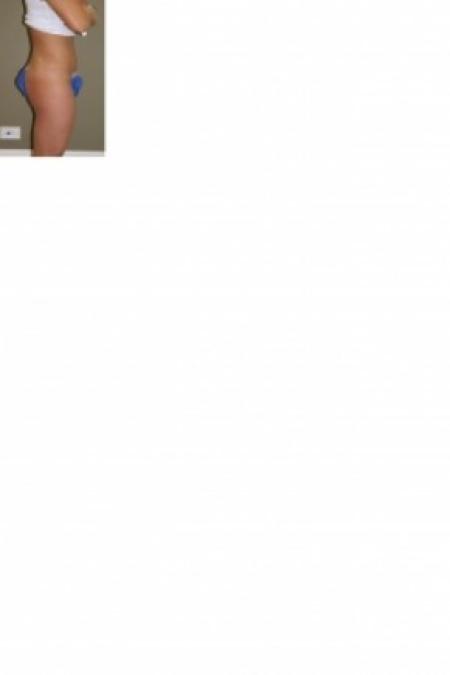 After image 2 Case #81281 - Liposuction